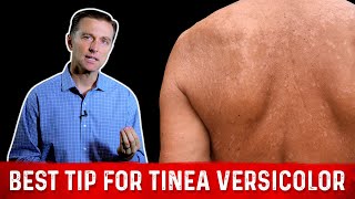 Natural Skin Fungus Tinea Versicolor Home Remedies – Dr Berg [upl. by Naved225]