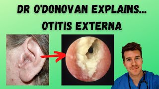 Explaining Otitis Externa  With Dr ODonovan [upl. by Anauj]