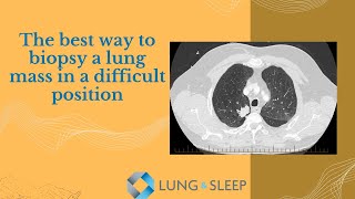 Rigid bronchoscopy and lung mass in the right upper lobe [upl. by Areip300]