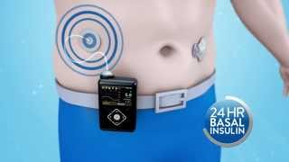 Medtronic MiniMed  How does the MiniMed 640G insulin pump work [upl. by Halli737]