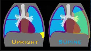 Pleural Effusion Explained by Prometheus Lionhart MD [upl. by Lemrac138]