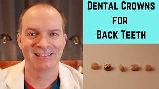 Dental Crown options for Back teeth [upl. by Hamford]