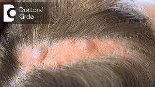 What causes Sebaceous Cyst on the scalp  Dr Nischal K [upl. by Miah]