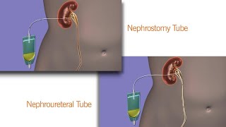 All You Need To Know About Drains After Surgery [upl. by Laux793]