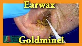 Earwax GOLDMINE  Auburn Medical Group [upl. by Ynnub873]