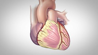 Solitaire™ FR Revascularization Device [upl. by Amye]