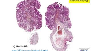 Colon Familial Adenomatous Polyposis [upl. by Hniht]