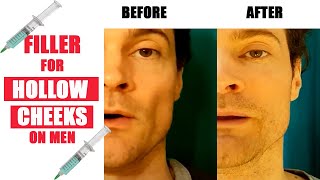 Dermal Filler Rejuvenation Men  Replace Lost Cheek Volume [upl. by Jolynn107]