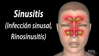 Sinusitis Animación Alila Medical Media Español [upl. by Rebor]