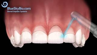 Patient Treatment Videos Gingivectomy [upl. by Zebada863]