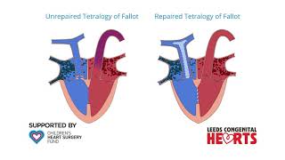 Tetralogy of Fallot [upl. by Seaden853]