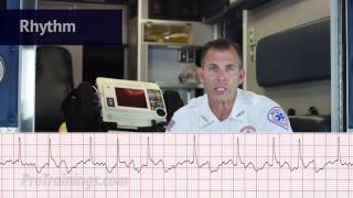 Atrial Fibrillation ECG Rhythm Interpretation [upl. by Bailar]