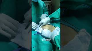 Hernia Inguinal Encarcerada [upl. by Arakal8]