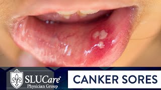 Determining Causes amp Treatment for Canker Sores  SLUCare Otolaryngology [upl. by Yahsat]