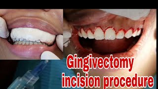 Gingivectomy incision procedure  gum cutting [upl. by Gardener]