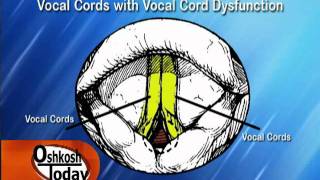 Vocal Cord Dysfunction [upl. by Goodyear859]