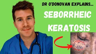 Explaining Seborrheic Keratosis  With Dr ODonovan [upl. by Notreb]