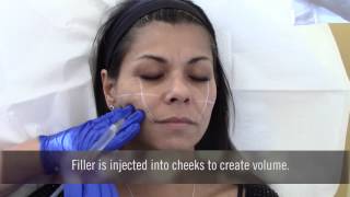 Injecting fillers in cheeks at Advanced Dermatology [upl. by Nalniuq313]