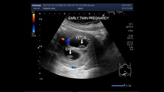 Early first trimester twin Pregnancy  08 weeks [upl. by Adnalue]