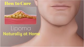 How to Treat Lipoma Without Surgery How to Cure Lipoma 5 Ways to Get Rid of a Lipoma Naturally [upl. by Nazario]