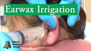 Ear Wax Irrigation  Auburn Medical Group [upl. by Yellas]