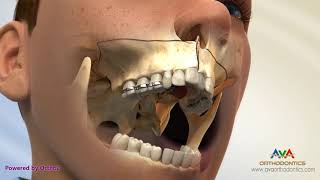 Surgical Orthodontic Treatment for Constricted Upper Jaw  SARPE [upl. by Adnauqahs]