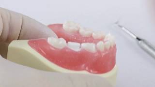 Pediatric Zirconia Crown Technique  Posterior [upl. by Button883]