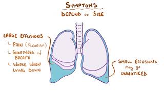 Pleural Effusion causes symptoms diagnosis treatment pathology [upl. by Ainex791]