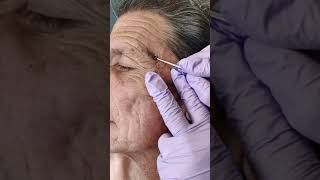 Acne extraction of blackheads and whiteheads popping pimples in Los Angeles [upl. by Lalat286]