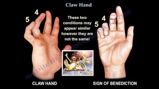 Claw Hand Ulnar Claw Hand  Everything You Need To Know  Dr Nabil Ebraheim [upl. by Harbird569]