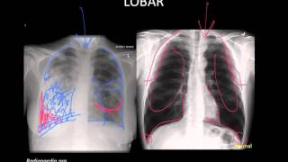 Pneumonia Imaging [upl. by Eneiluj402]