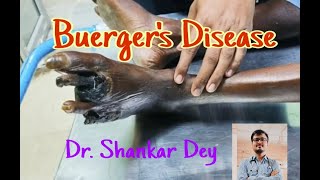 Buergers Disease  Case Demonstration  Dr Shankar Dey [upl. by Greenberg]