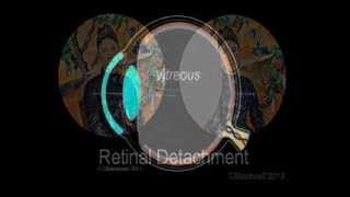 Retinal Detachment [upl. by Halian]