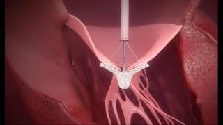 TEER Procedure with MitraClip Therapy [upl. by Mettah]