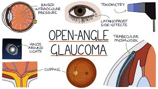 Understanding Acute Angle Closure Glaucoma [upl. by Ahsiuqal465]