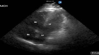 Pulmonary Embolus McConnells Sign [upl. by Nyliac856]