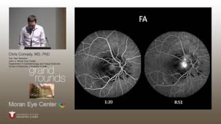 Optic Disc Edema and Choroidal Neovascular Membranes [upl. by Eirol]