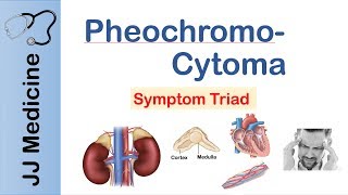 Pheochromocytoma  Symptoms and Treatment [upl. by Sandry]