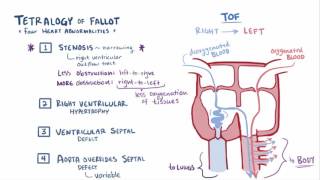 Tetralogy of Fallot Pathogenesis Signs and Management Everything you need to know [upl. by Gawain157]