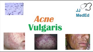 Acne Vulgaris  Causes Pathogenesis Influencing Factors Diagnosis Treatment and Complications [upl. by Kalikow]