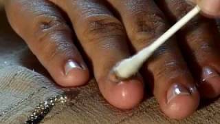 How to Cure Nail Fungus [upl. by Atiuqad]