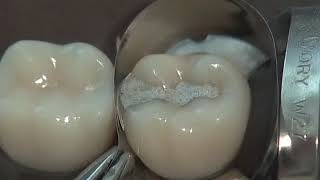 Class II Amalgam Preparation amp Restoration  Operative Dentistry [upl. by Murphy]