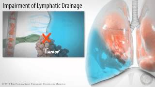 Pleural Space Part 3 of 3 Pleural Effusions HD [upl. by Asamot576]