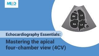 Right Ventricular Dilation Submassive PE Ultrasound Parasternal long [upl. by Collayer509]