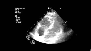 Echocardiography to Assess MitralValve Leaflets  NEJM [upl. by Lothair]