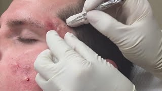 Super Satisfying Blackhead Removal [upl. by Haywood]