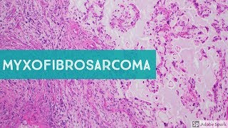 Chondrosarcoma vs Enchondroma Bone Pathology with Dr Andrew Rosenberg [upl. by Sunderland]