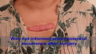 Chest Keloids  Mistakes to Avoid [upl. by Eerolam115]