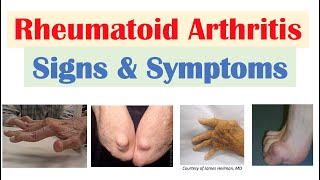 Rheumatoid Arthritis RA Signs amp Symptoms amp Associated Complications [upl. by Hake660]