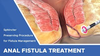 10second assessment for fistulas quotFree Dialysis Video Trainingquot [upl. by Bassett]